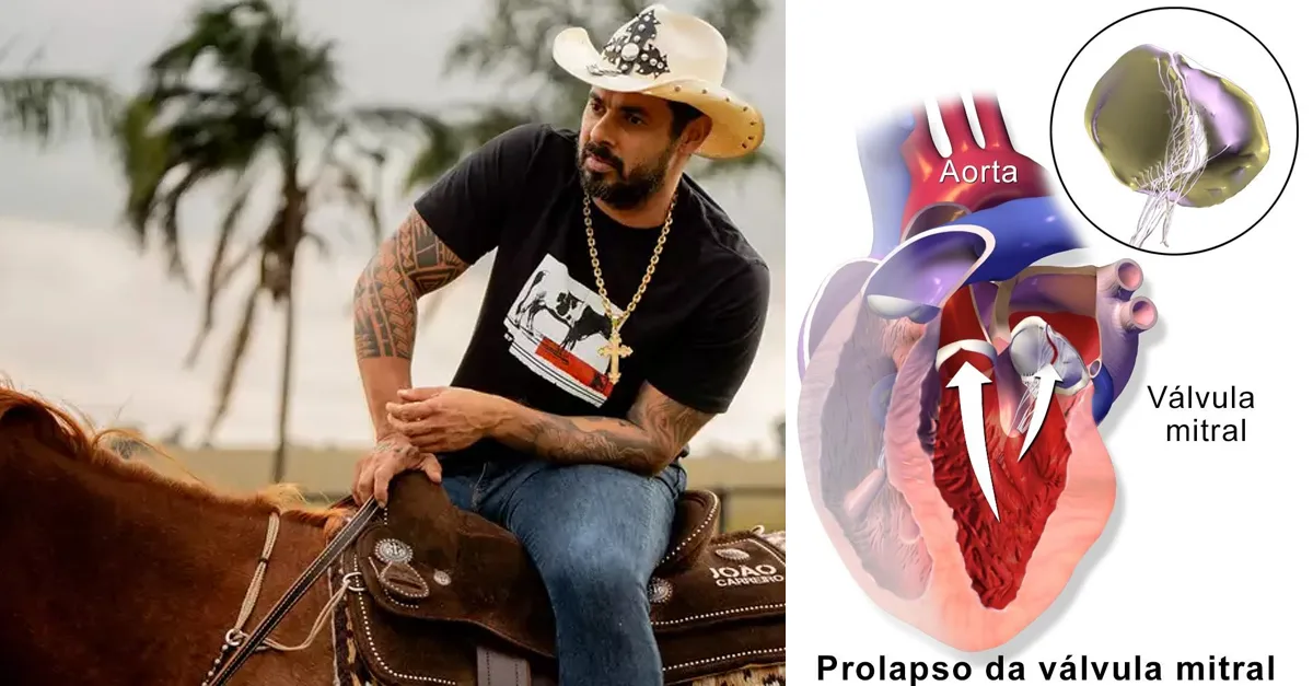 Prolapso da Válvula Mitral: Entenda a Condição Cardíaca que Levou à Cirurgia e à Morte de João Carreiro