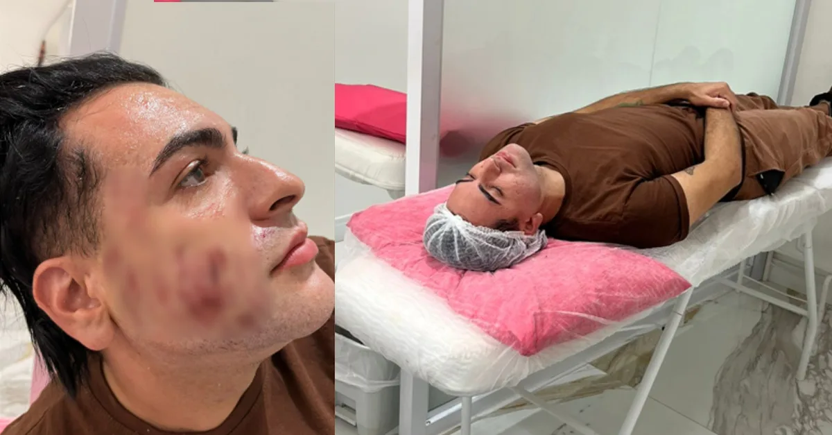 Empresário Morre Após Pagar R$ 4.500 por Peeling de Fenol em Clínica de SP