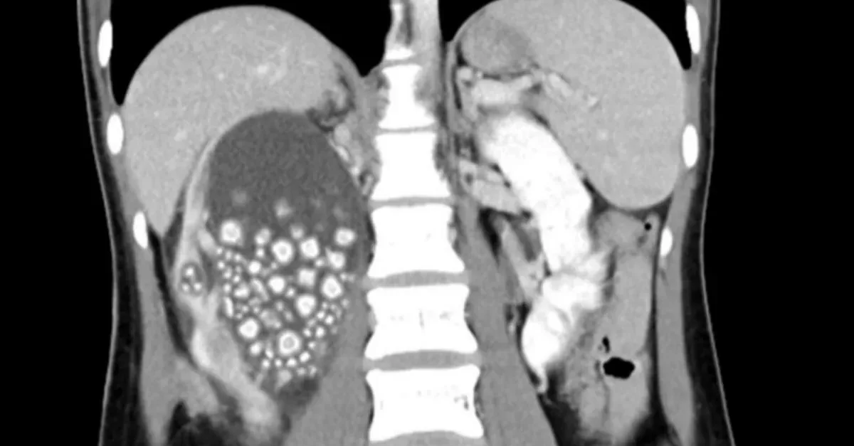 Desidratação Extrema: Cirurgia Retira mais de 300 Pedras do Rim de Jovem em Taiwan