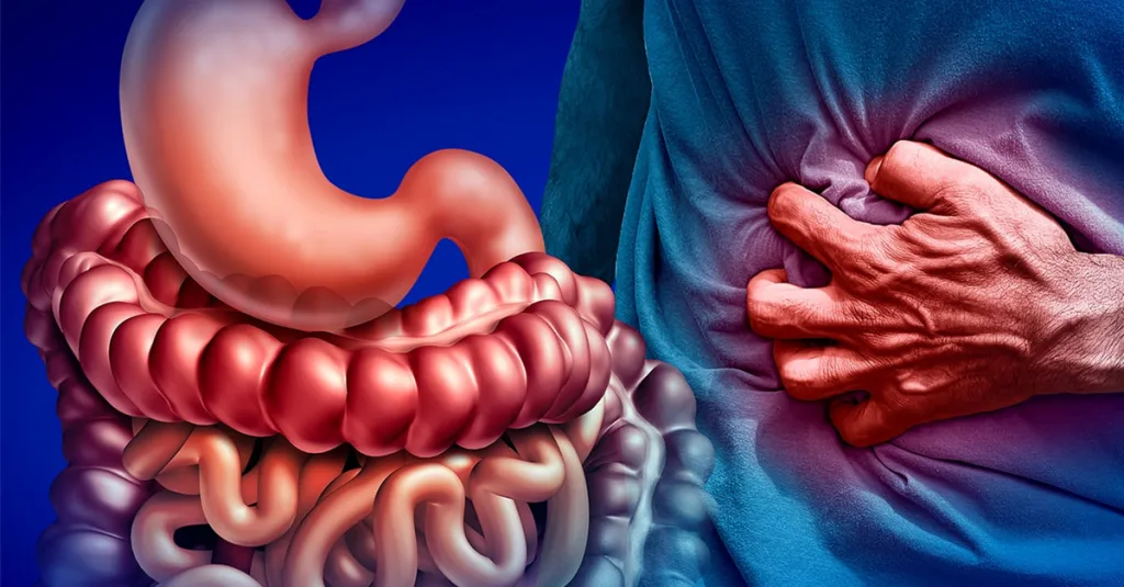 Doença Inflamatória Intestinal: Desafios de Tratamento e Inovações Médicas