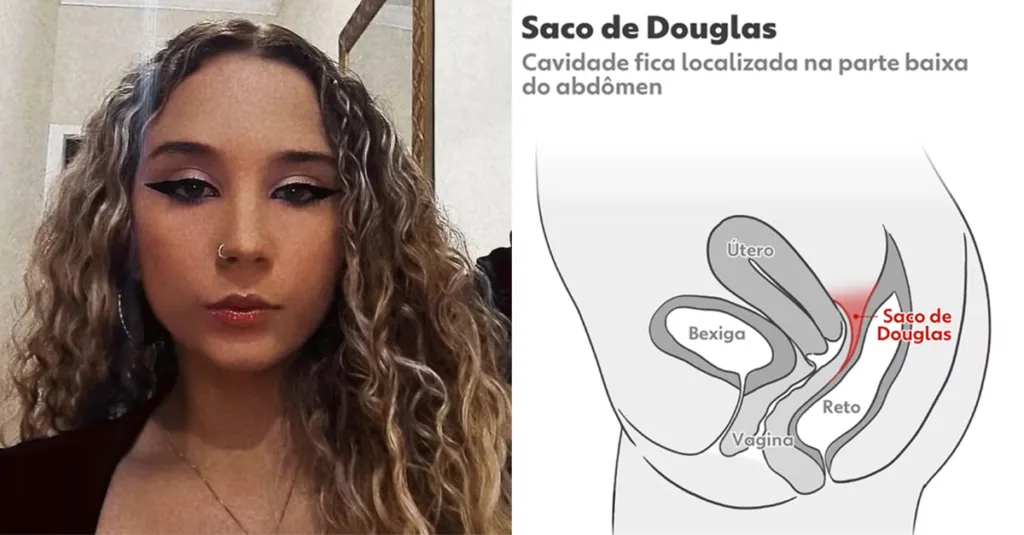 Ruptura no Saco de Douglas durante Atividade Sexual: Compreendendo os Riscos