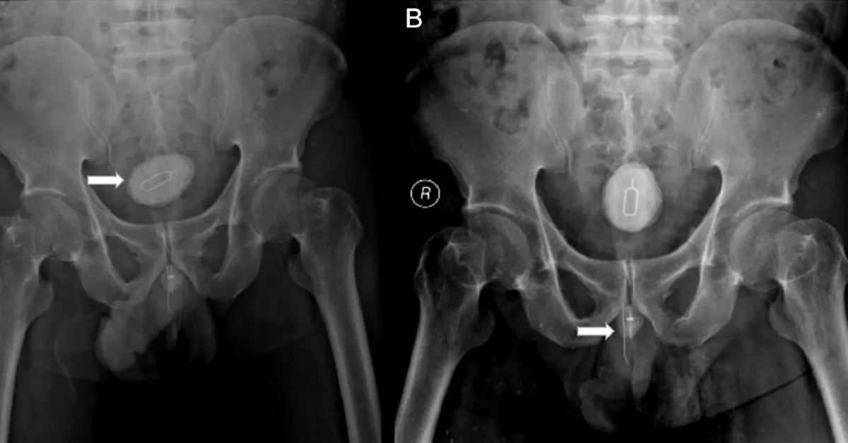 Homem Submetido a Cirurgia Após Tentativa Bizarra de Remover Chip de Celular do Órgão Genital