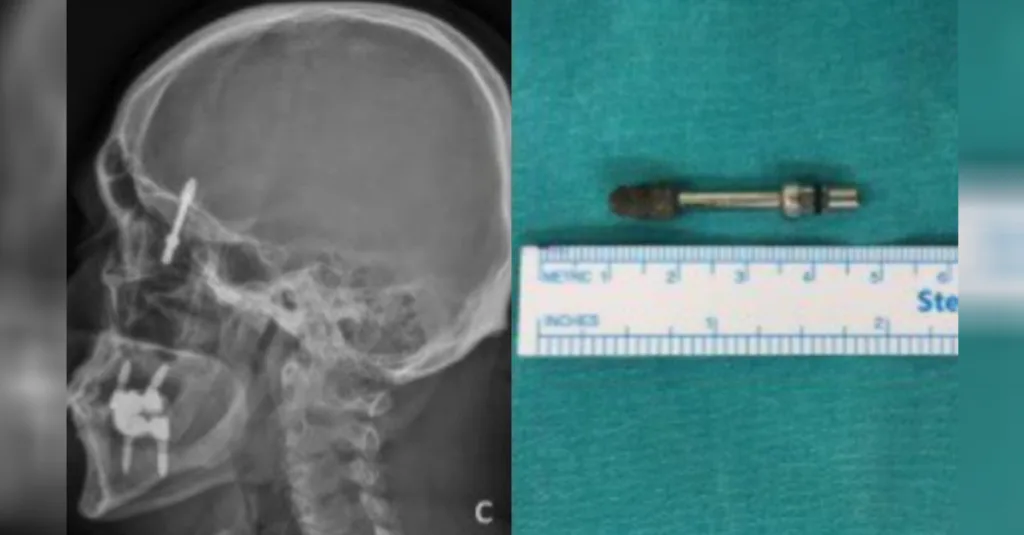 Implante Dentário: Parafuso se Desloca para o Cérebro de Paciente em Procedimento Traumático